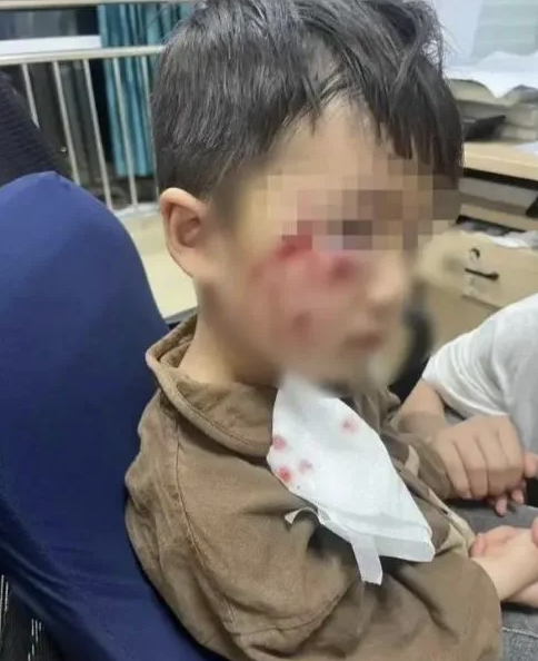 被疯犬咬伤没有“救命药”，怎么办？